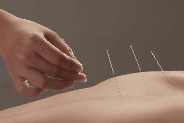 Acupuncture Treatment in Dubai | Traditional Chinese Medicine Specialist Dubai